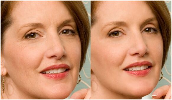 antes y después del rejuvenecimiento de la piel facial con plasma
