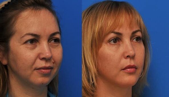 antes y después del rejuvenecimiento de la piel con foto de estiramiento 1