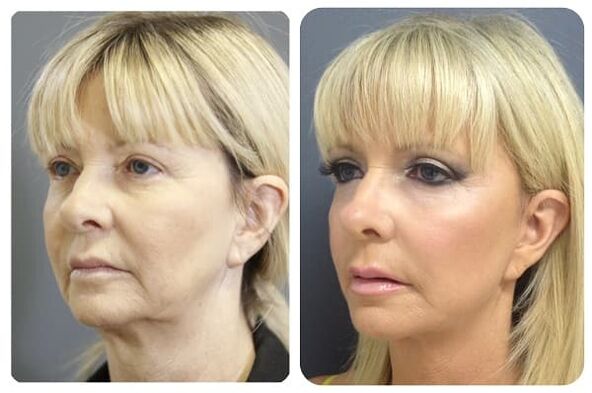 antes y después del rejuvenecimiento de la piel con foto de estiramiento 2