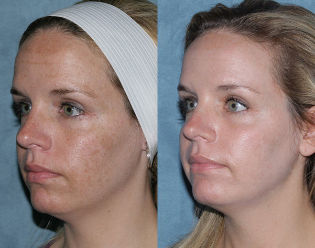 Fotos de antes y después de la fracciones de de rejuvenecimiento facial