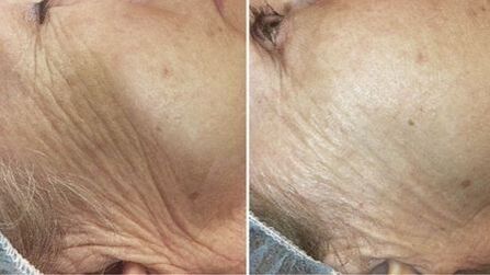 antes y después del rejuvenecimiento de la piel con láser